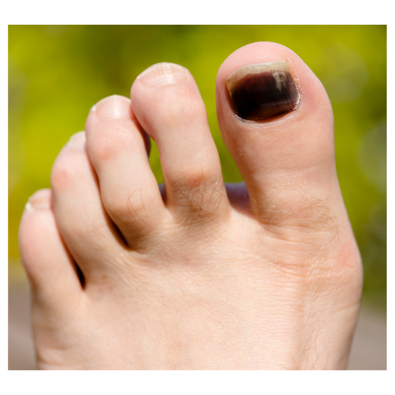 foot with black toenail